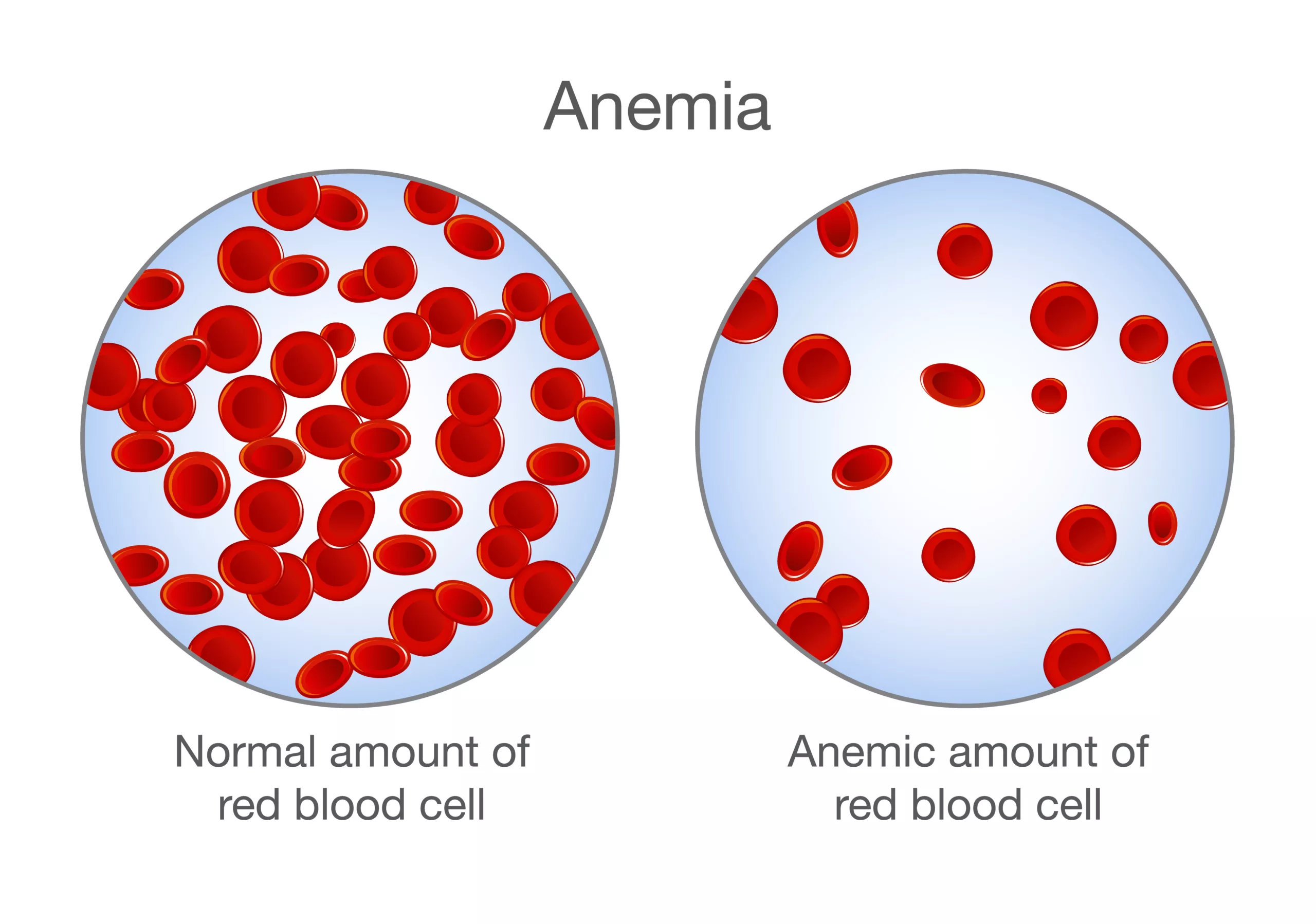 The difference of Anemia amount of red blood cell and normal. Medical illustration showing the difference between normal red blood cells and reduced red blood cell count in anemia.