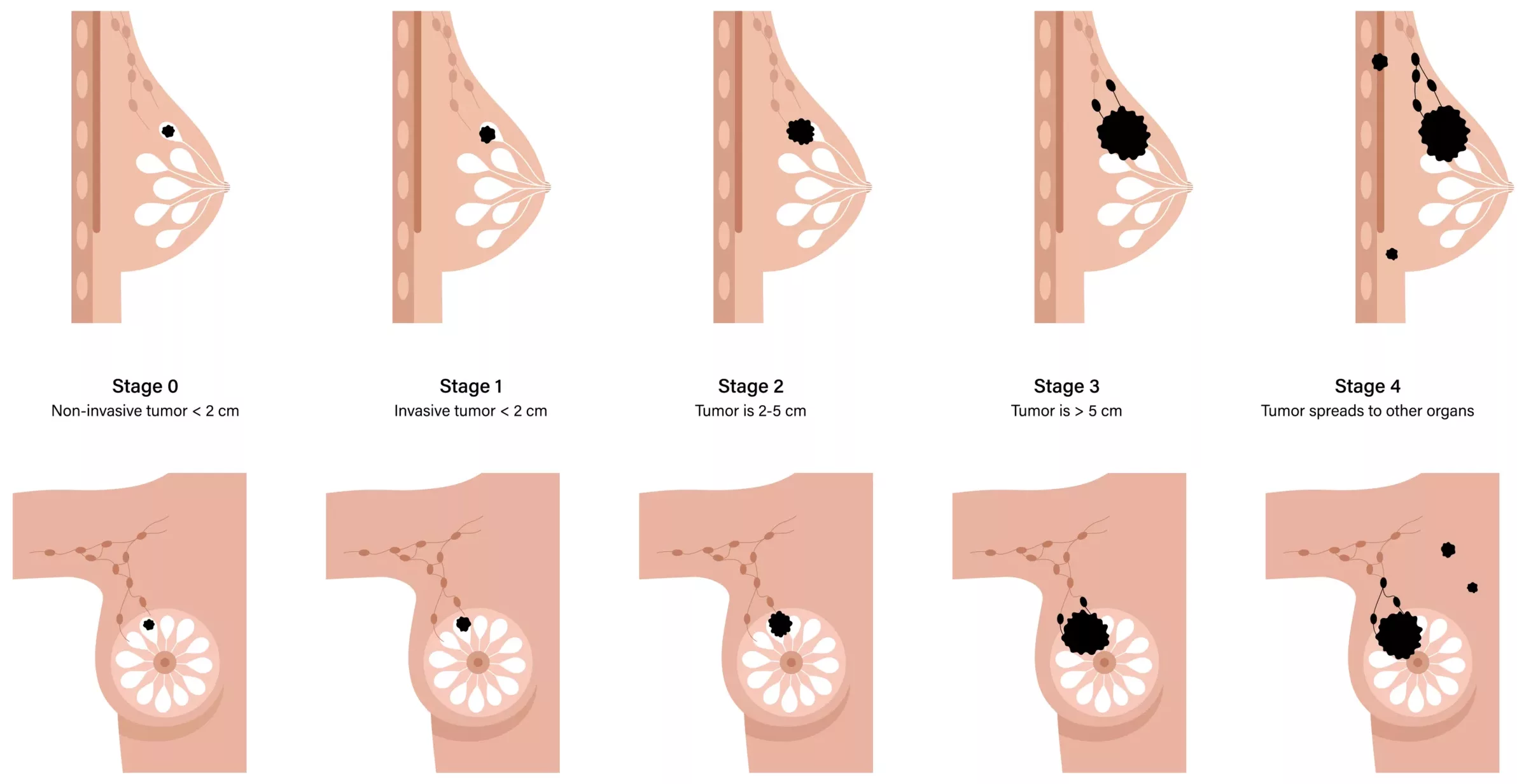 Breast Cancer Staging Diagram A medical illustration showing breast cancer stages 0 through 4. Each stage is represented by a cross-section of a breast, with tumors increasing in size and spread. Stage 0 shows a small, non-invasive tumor. Stage 1 shows a small invasive tumor under 2 cm. Stage 2 shows a tumor 2–5 cm. Stage 3 shows a tumor over 5 cm with lymph node involvement. Stage 4 shows the cancer spreading beyond the breast to other organs.