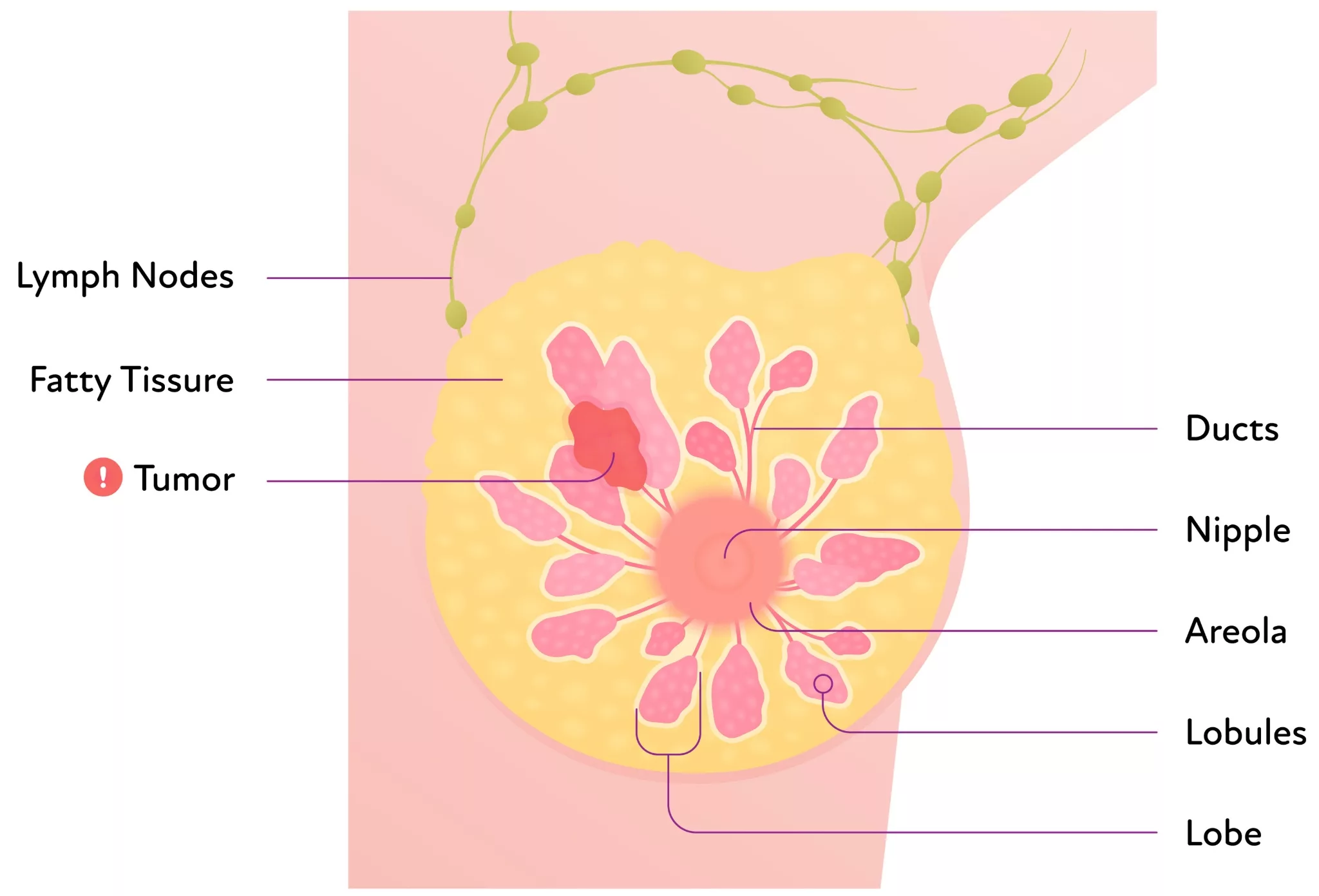 Breast Anatomy and Tumor Location in Breast Cancer An illustrated cross-section of the female breast showing internal structures labeled: lymph nodes, fatty tissue, ducts, lobules, lobe, nipple, areola, and a tumor. The tumor is marked in red and located within the fatty tissue and ducts.