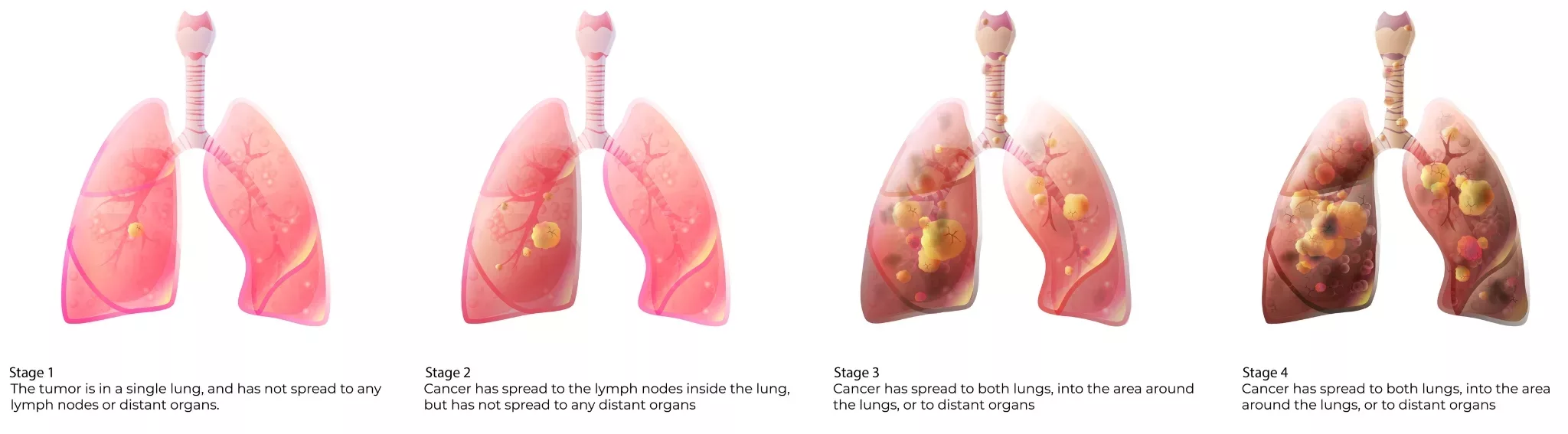Lung Cancer Staging Progression An illustrated progression of lung cancer stages from 1 to 4. Stage 1 shows a single tumor in one lung. Stage 2 shows cancer spreading to nearby lymph nodes. Stage 3 shows multiple tumors affecting both lungs and surrounding areas. Stage 4 shows widespread cancer in both lungs and other organs, representing advanced disease.