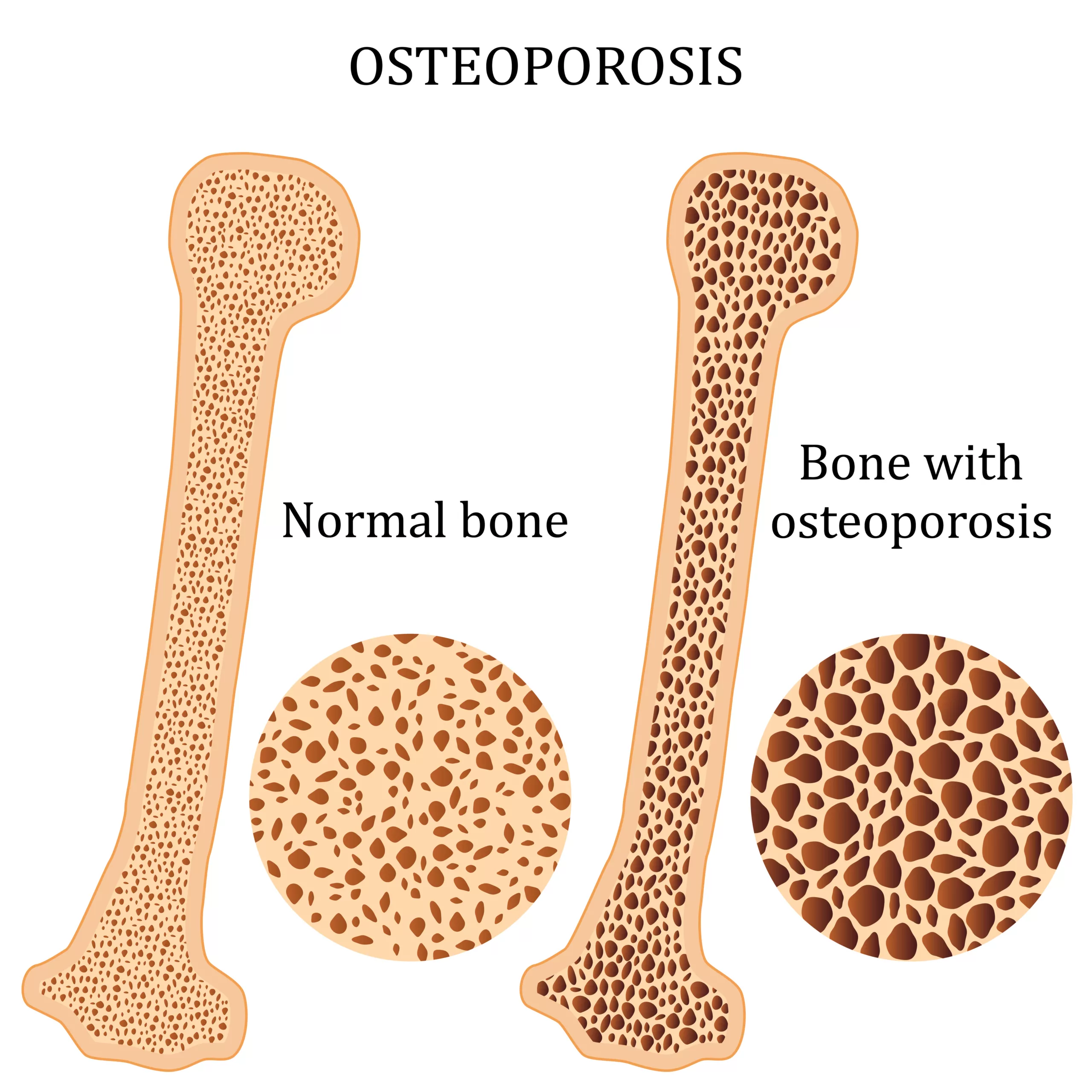 Normal Bone vs. Osteoporotic Bone Illustration Comparison of normal bone and bone with osteoporosis showing bone density loss.